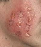 Create 1st & 2nd Degree Burns Create 1st & 2nd Degree Burns