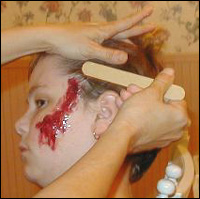 Using Gelatin for Burns & Scars Using Gelatin for Burns & Scars
