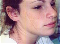 Creating Scars & Burns with Collodion Creating Scars & Burns with Collodion
