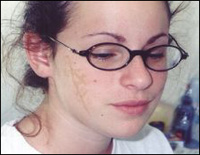 Creating Scars & Burns with Collodion Creating Scars & Burns with Collodion