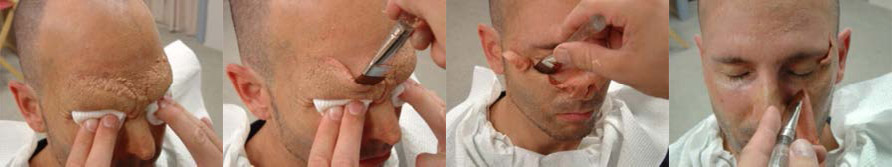 Removing a Foam Prosthetic